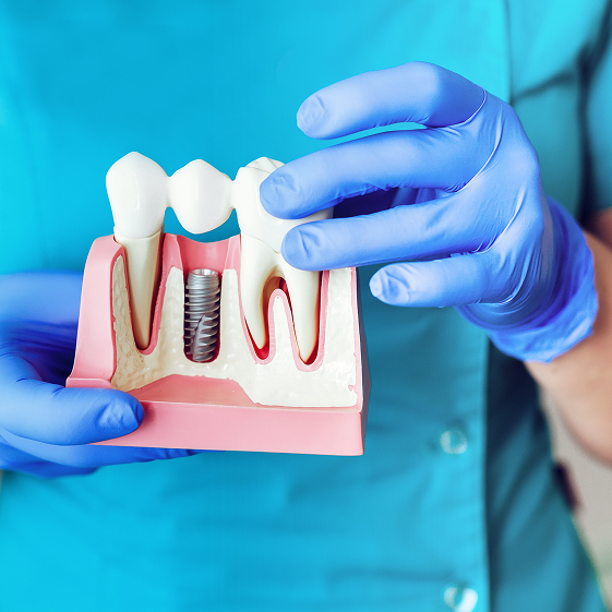 Many Dental Implants Can You Have At Once